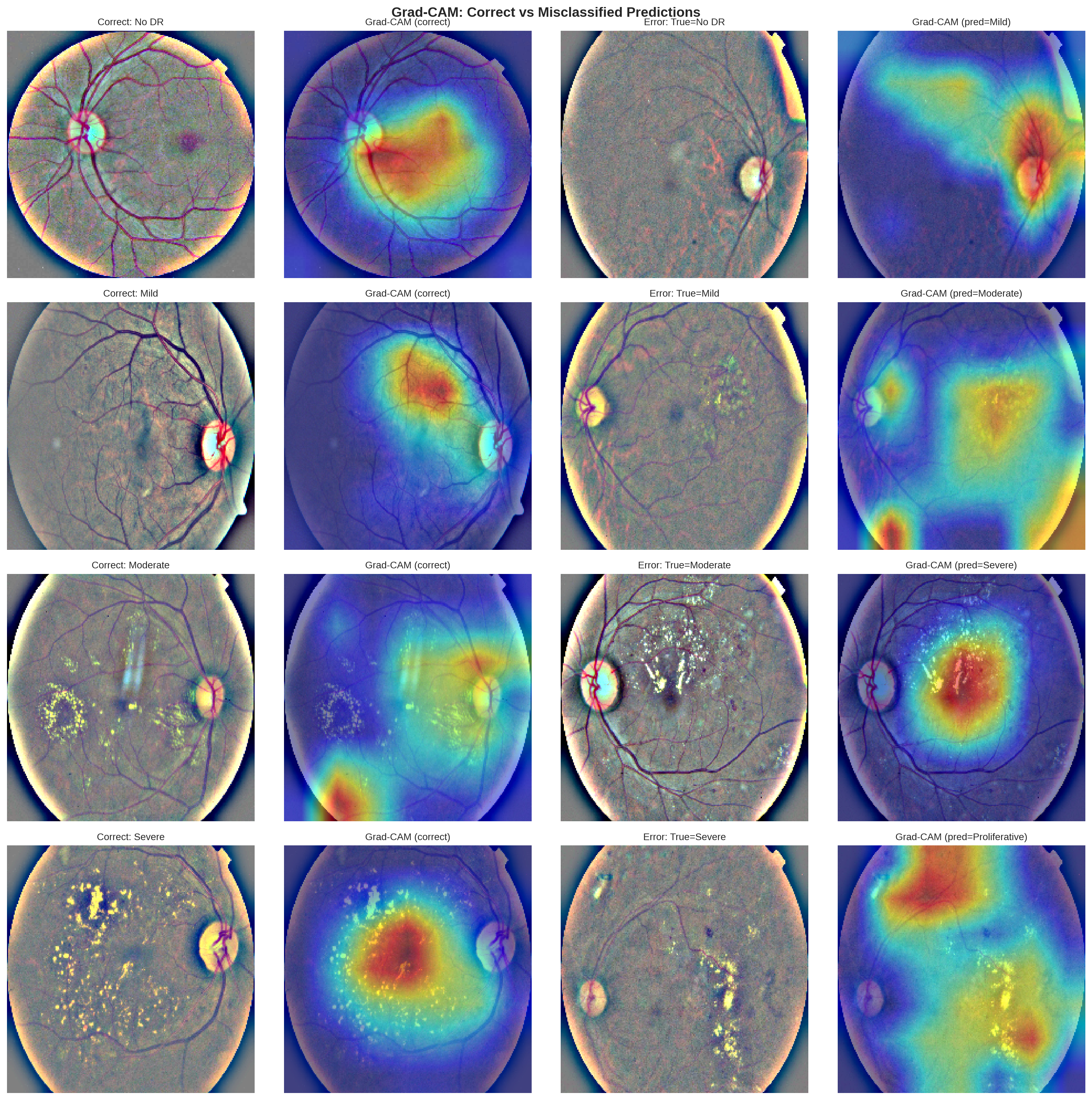 Grad-CAM heat maps on misclassified retinal images, showing where the model's attention falls when it grades incorrectly