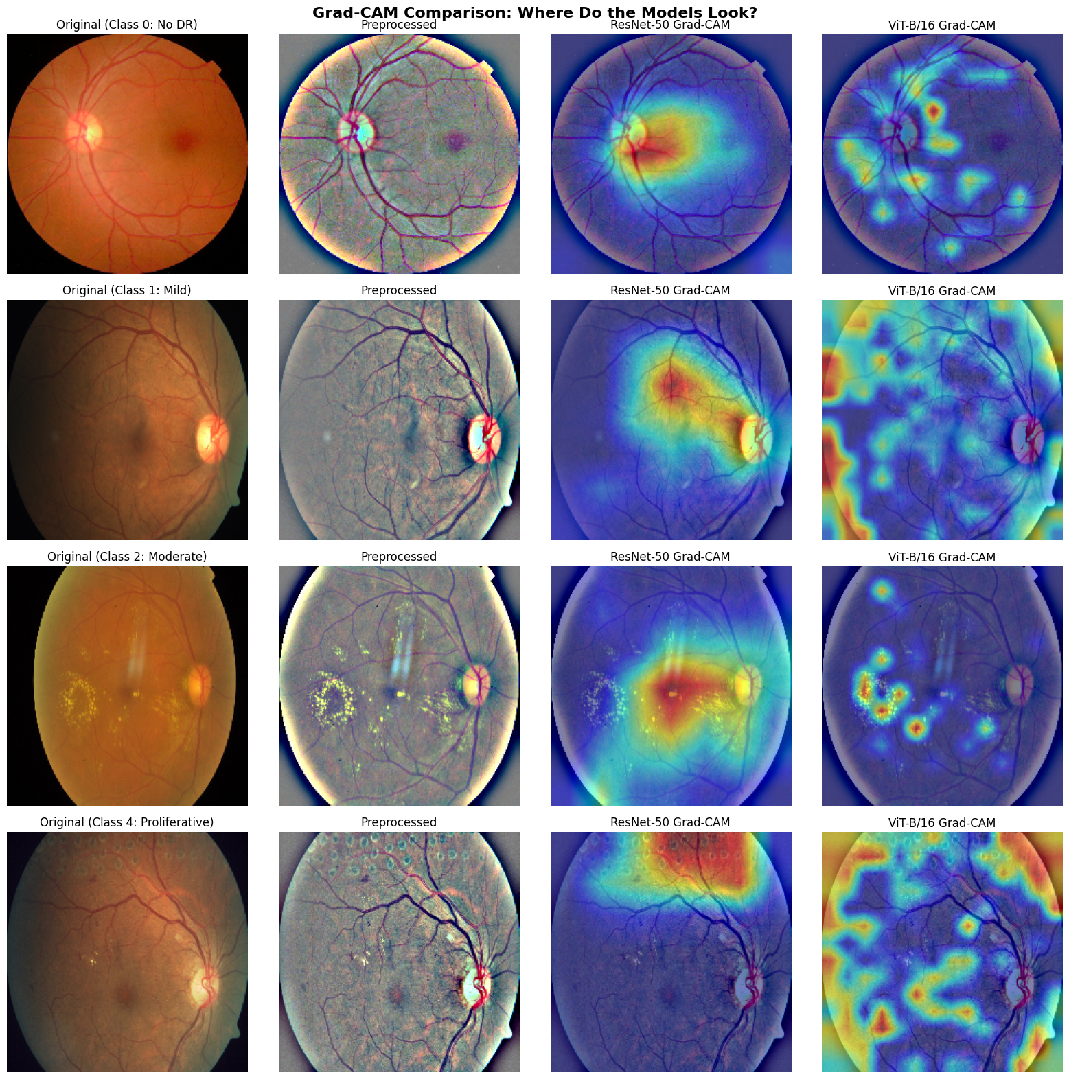 Grad-CAM heat maps comparing where the CNN and Vision Transformer focus on retinal images